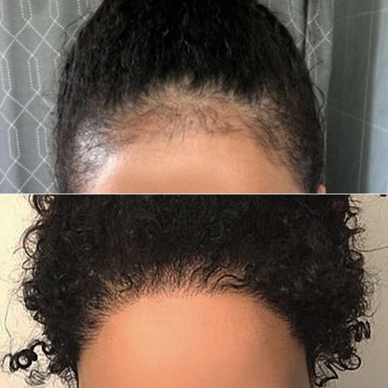 Hair Transplant UK: Restore Your Confidence with Natural Results